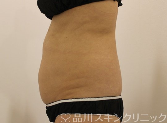 症例NO.65574のBEFORE写真