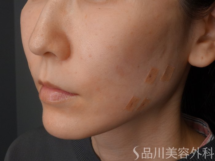 症例NO.73721のAFTER写真