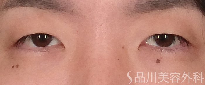 症例NO.70417のBEFORE写真