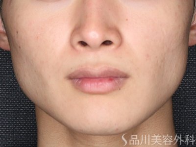 症例NO.74923のAFTER写真