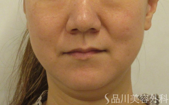 症例NO.71577のBEFORE写真