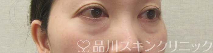 症例NO.69585のBEFORE写真