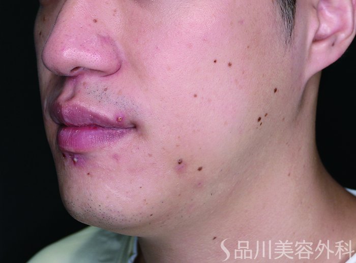 症例NO.72399のBEFORE写真