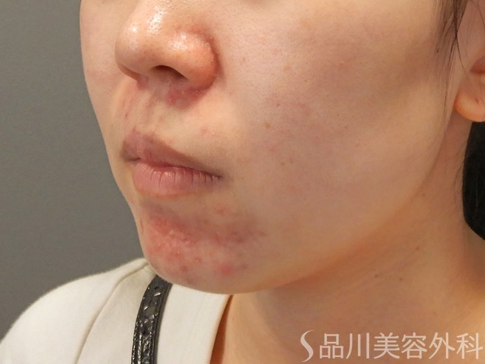 症例NO.70852のBEFORE写真