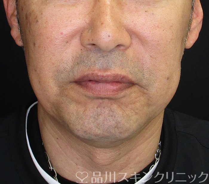 症例NO.74111のBEFORE写真