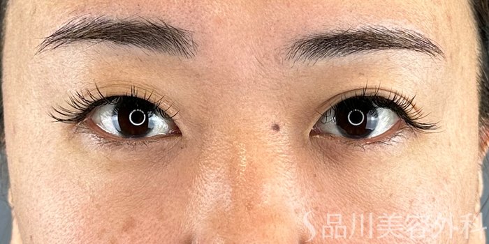 症例NO.70421のBEFORE写真