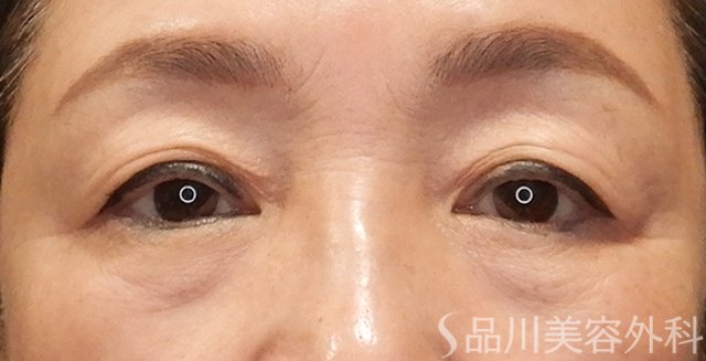 症例NO.73283のBEFORE写真