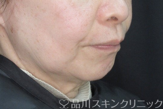 症例NO.73416のBEFORE写真