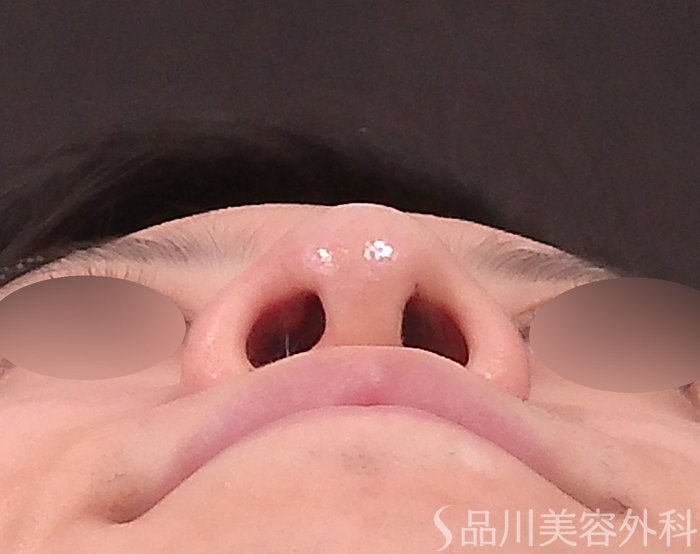 症例NO.70330のAFTER写真