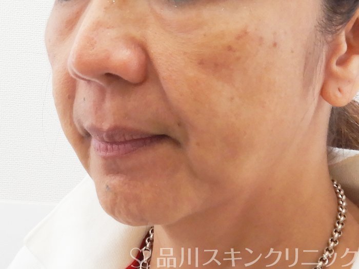 症例NO.63732のBEFORE写真