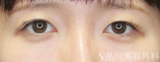 症例NO.70398のBEFORE写真