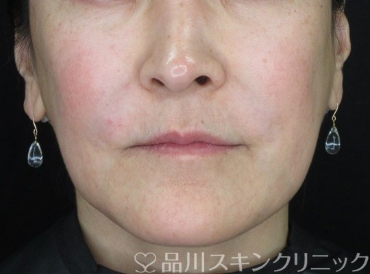症例NO.69567のBEFORE写真