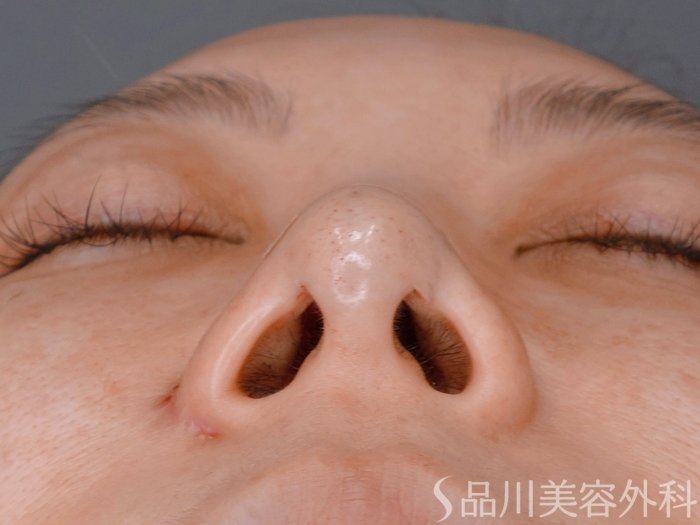 症例NO.73608のAFTER写真