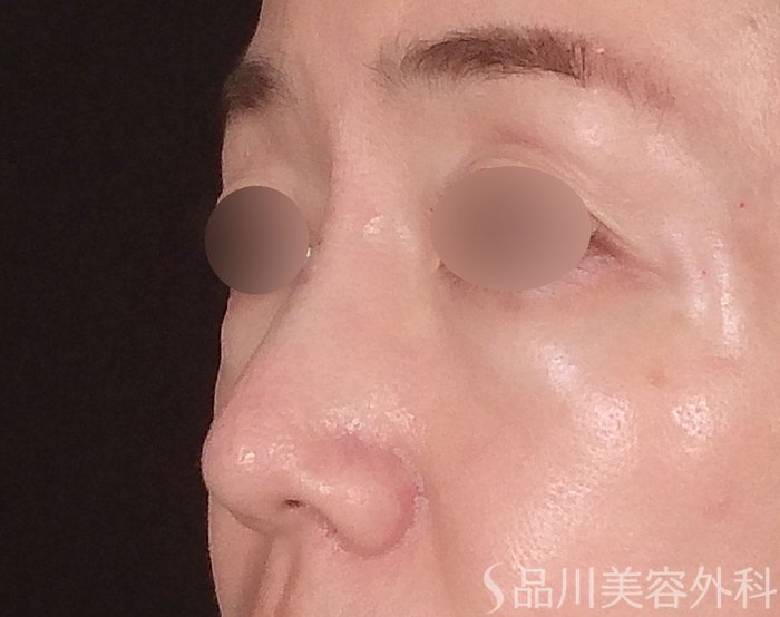 症例NO.70440のAFTER写真