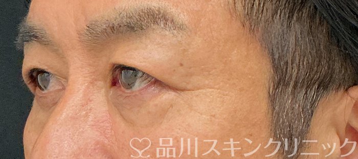 症例NO.74818のBEFORE写真
