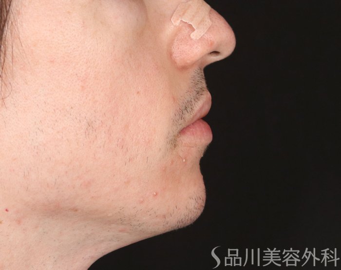 症例NO.71625のAFTER写真