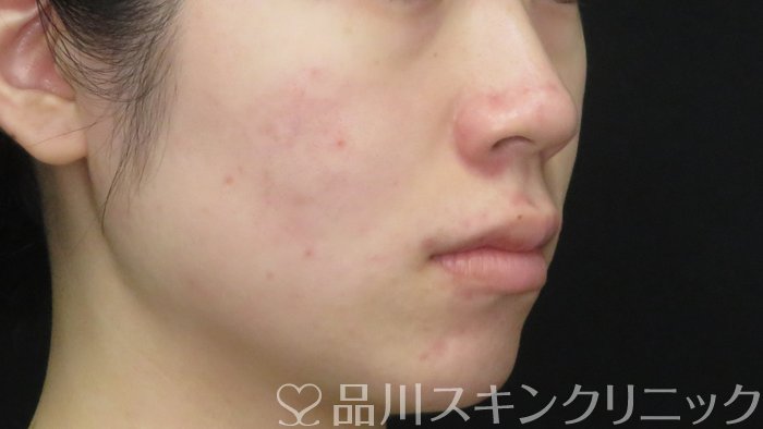 症例NO.71888のAFTER写真