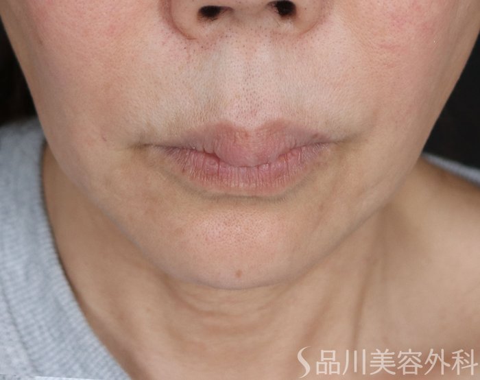 症例NO.72361のBEFORE写真