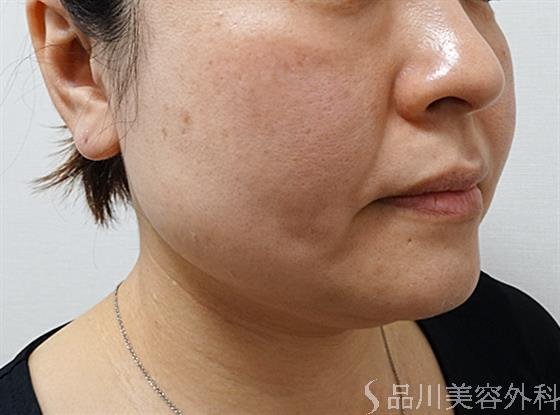 症例NO.55619のBEFORE写真