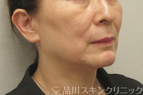 症例NO.74202のAFTER写真