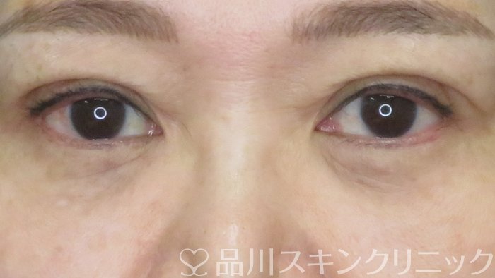 症例NO.71820のAFTER写真