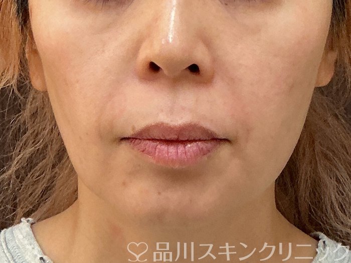 症例NO.73957のBEFORE写真