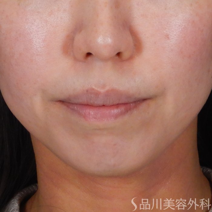 症例NO.67722のBEFORE写真
