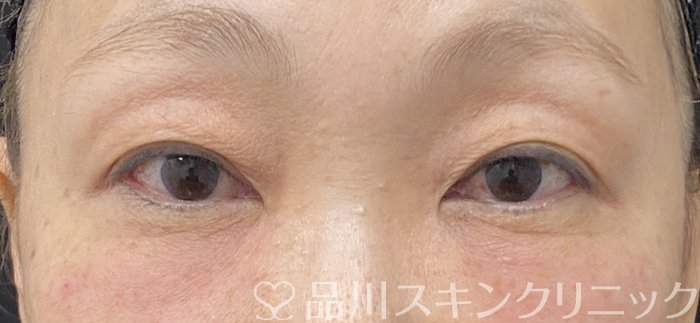 症例NO.74652のAFTER写真