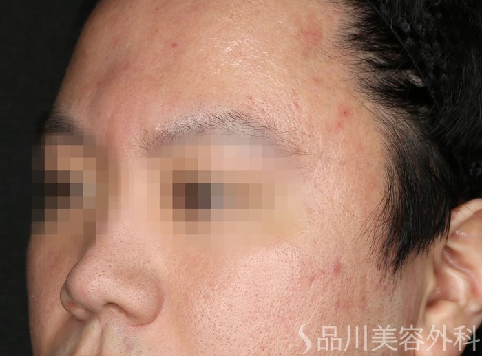 症例NO.73950のBEFORE写真