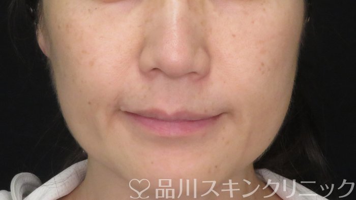 症例NO.70963のBEFORE写真