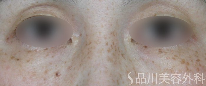 症例NO.65594のBEFORE写真