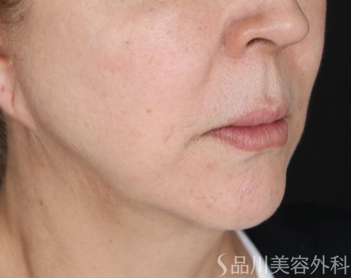 症例NO.73991のBEFORE写真