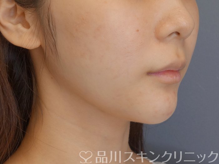 症例NO.71811のBEFORE写真