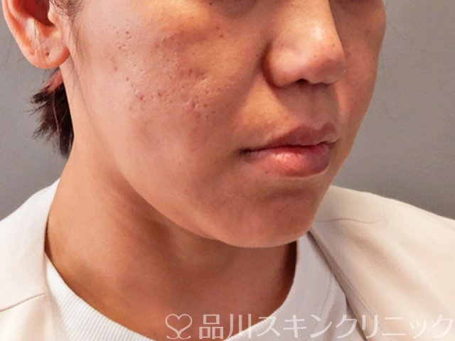 症例NO.70984のAFTER写真