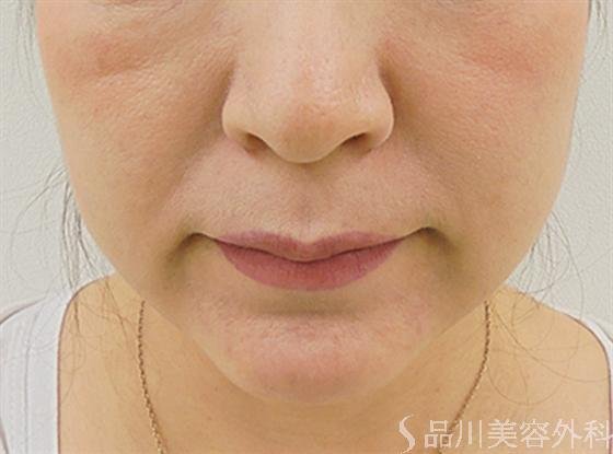 症例NO.16333のAFTER写真
