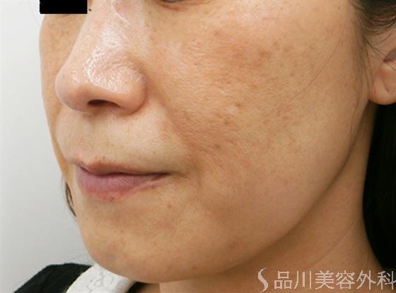 症例NO.31581のAFTER写真