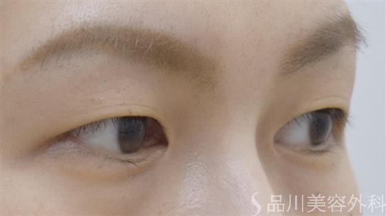 症例NO.52538のBEFORE写真