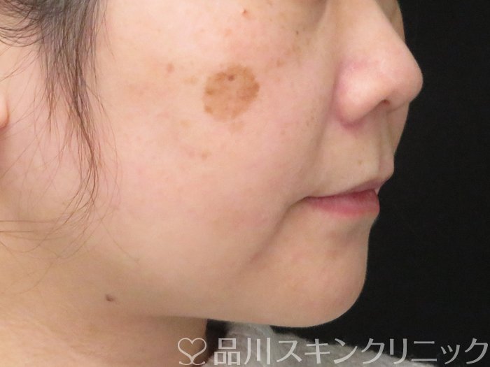 症例NO.69438のBEFORE写真