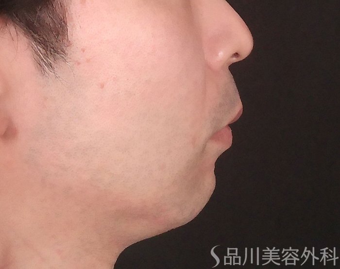 症例NO.69192のBEFORE写真