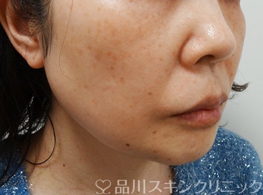 症例NO.70674のBEFORE写真