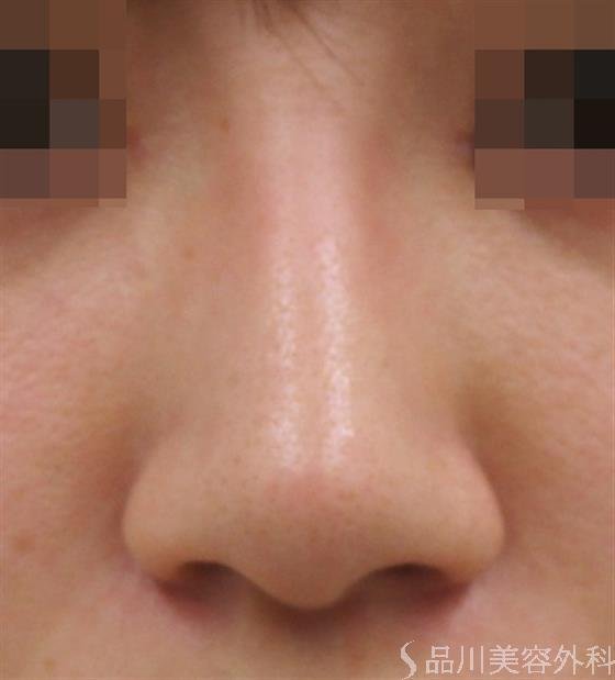 症例NO.43592のBEFORE写真