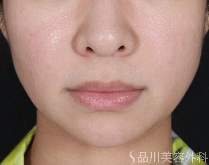 症例NO.71162のBEFORE写真