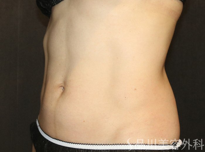 症例NO.72786のBEFORE写真