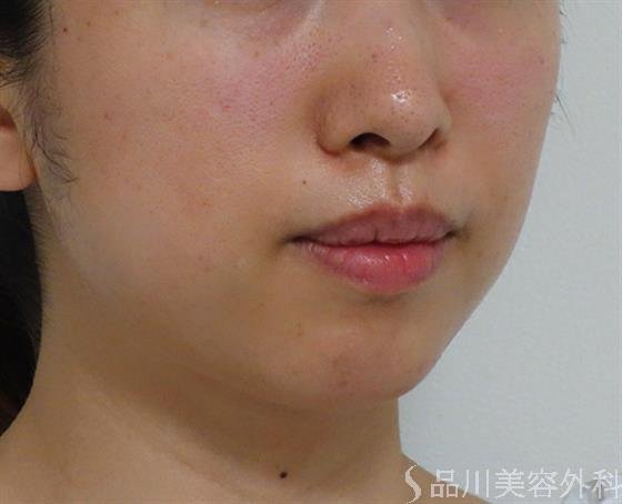 症例NO.39685のAFTER写真