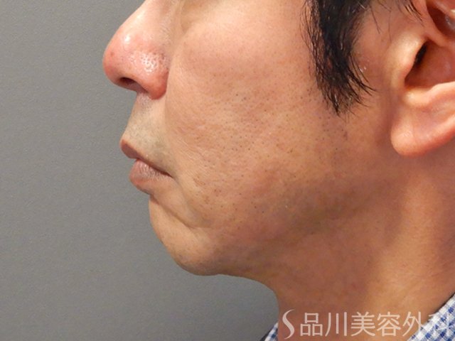 症例NO.73876のAFTER写真