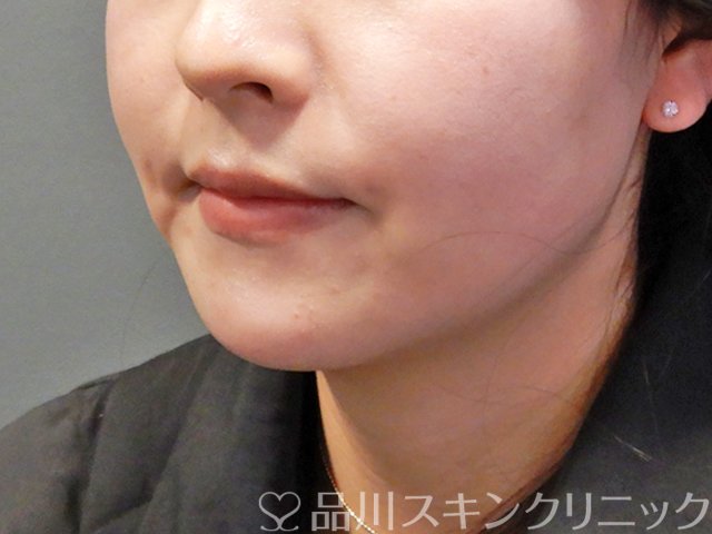 症例NO.68183のBEFORE写真