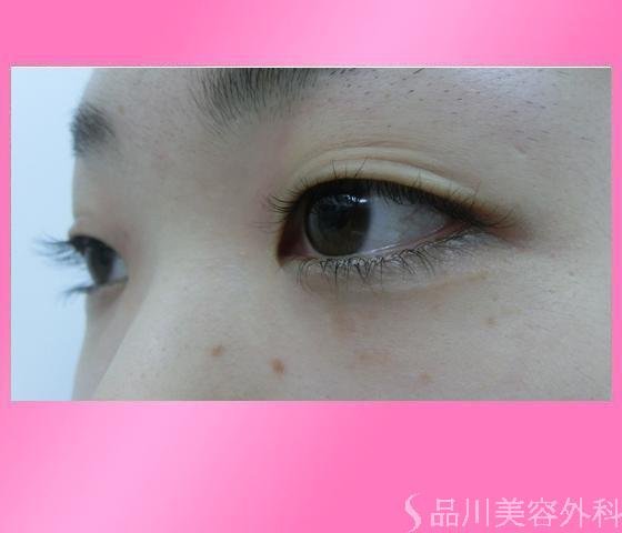 症例NO.14024のBEFORE写真