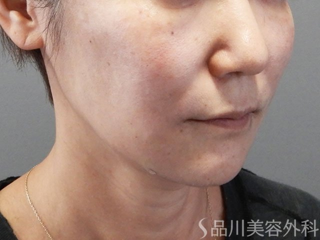 症例NO.71955のAFTER写真