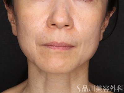症例NO.69237のAFTER写真