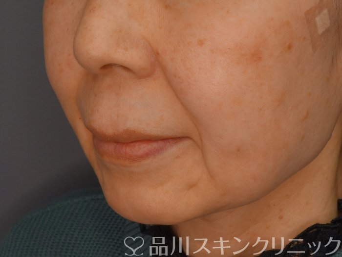 症例NO.75320のAFTER写真